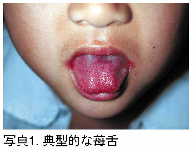 苺舌